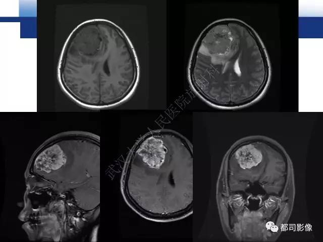 【病例】骨外间叶性软骨肉瘤1例MR影像诊断