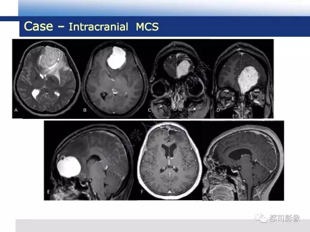 【病例】骨外间叶性软骨肉瘤1例MR影像诊断