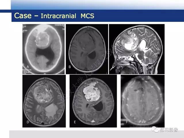 【病例】骨外间叶性软骨肉瘤1例MR影像诊断