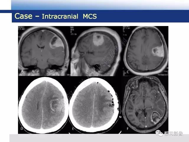 【病例】骨外间叶性软骨肉瘤1例MR影像诊断