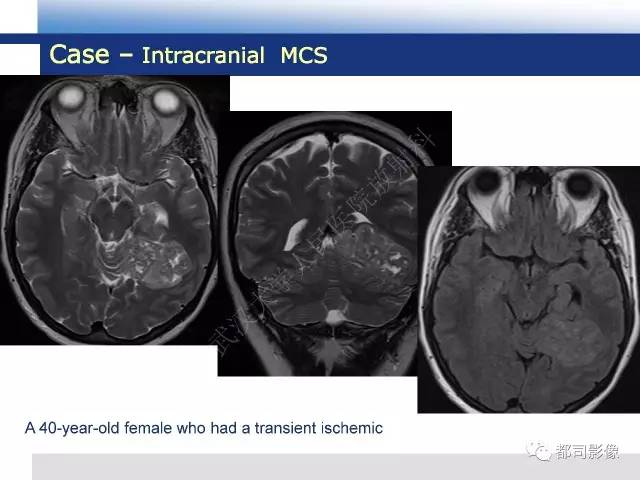 【病例】骨外间叶性软骨肉瘤1例MR影像诊断