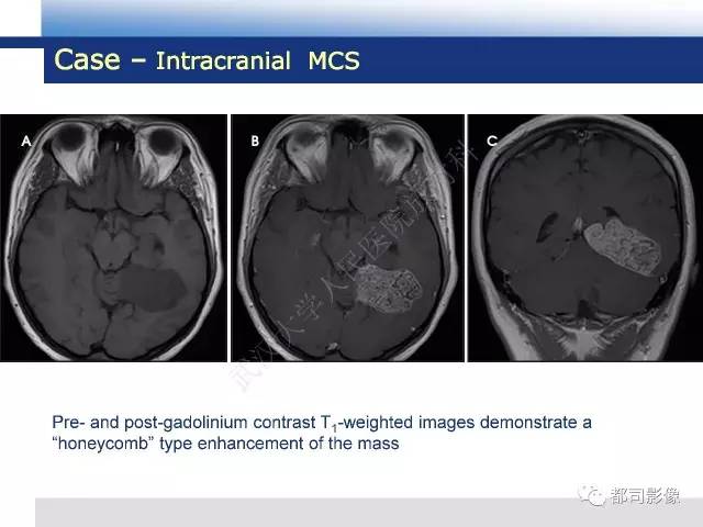 【病例】骨外间叶性软骨肉瘤1例MR影像诊断