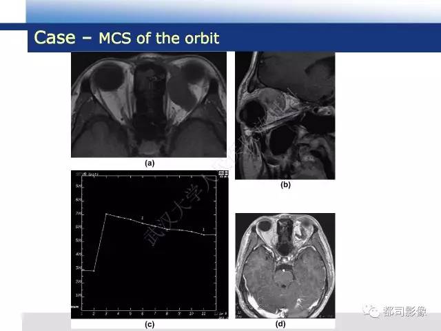 【病例】骨外间叶性软骨肉瘤1例MR影像诊断