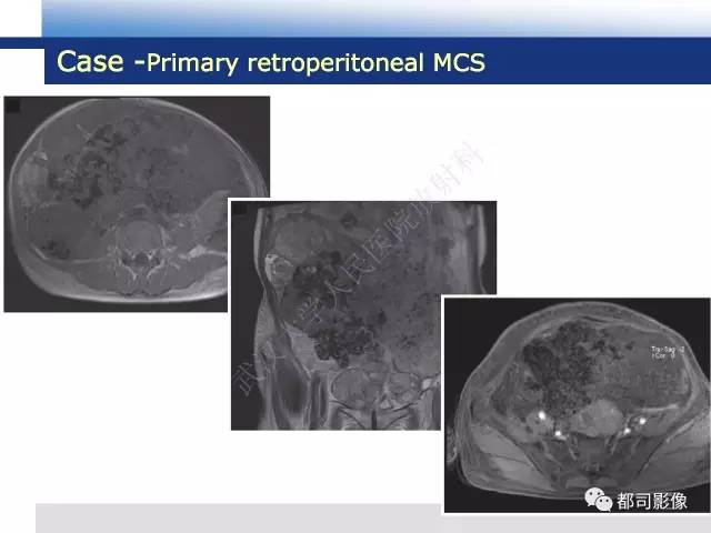 【病例】骨外间叶性软骨肉瘤1例MR影像诊断
