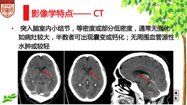 【病例】室管膜下瘤1例MR影像表现