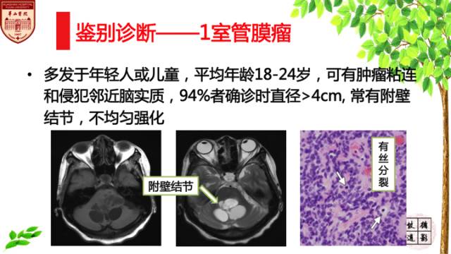 【病例】室管膜下瘤1例MR影像表现