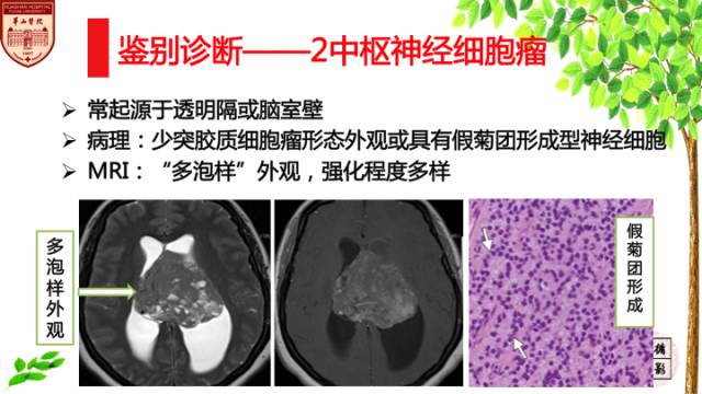 【病例】室管膜下瘤1例MR影像表现