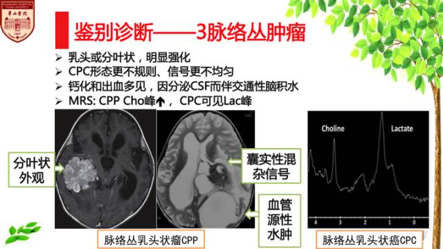 【病例】室管膜下瘤1例MR影像表现