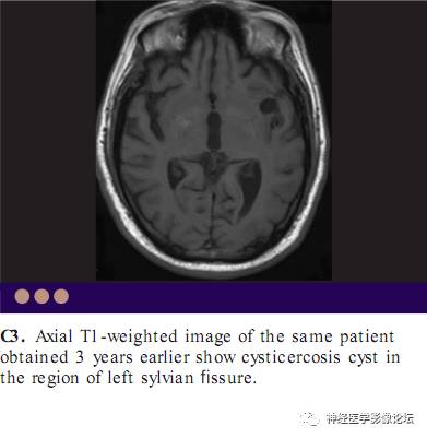 8种累及软脑膜病变 8种累及软脑膜病变