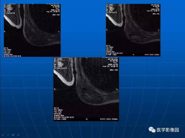 【病例】左肩背部海绵状血管瘤1例MR 【病例】左肩背部海绵状血管瘤1例MR