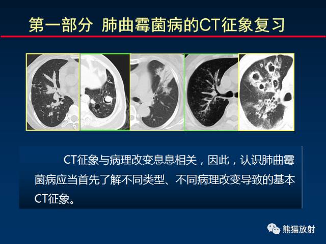 【PPT】小儿肺曲霉菌病相关CT表现分析