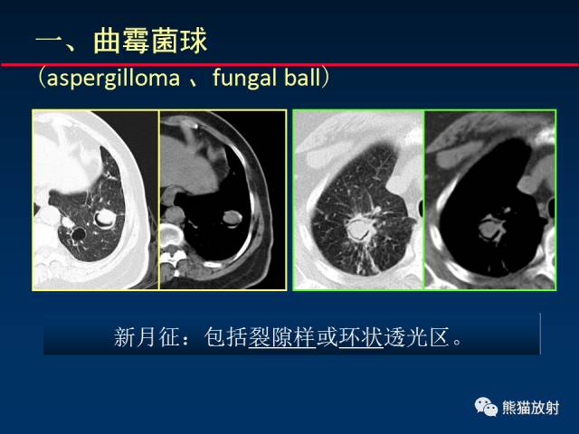 【PPT】小儿肺曲霉菌病相关CT表现分析