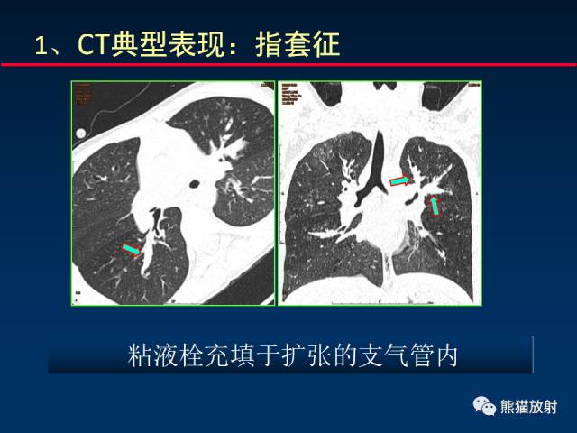 【PPT】小儿肺曲霉菌病相关CT表现分析