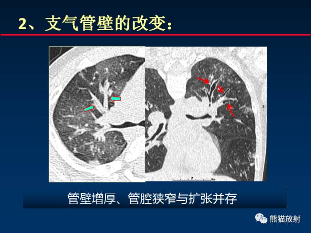 【PPT】小儿肺曲霉菌病相关CT表现分析