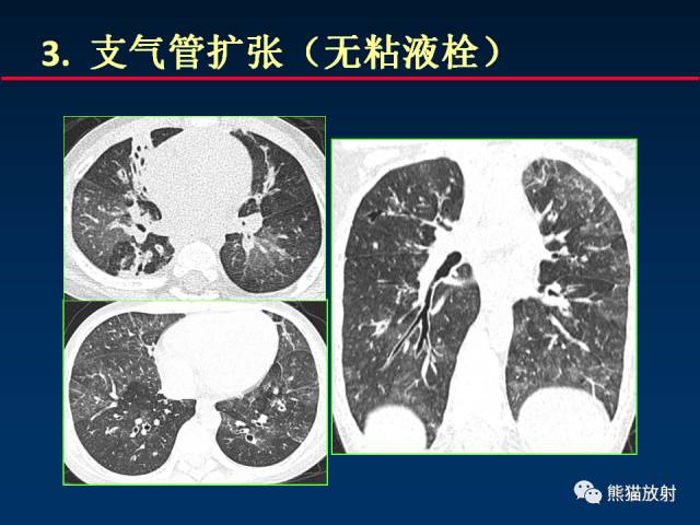 【PPT】小儿肺曲霉菌病相关CT表现分析