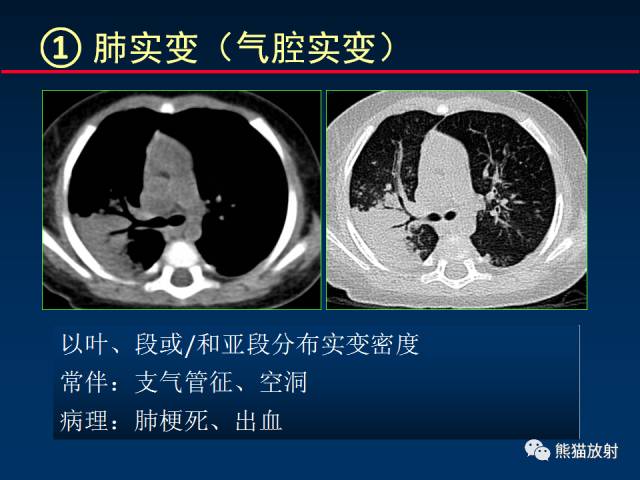 【PPT】小儿肺曲霉菌病相关CT表现分析
