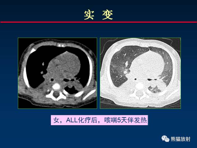 【PPT】小儿肺曲霉菌病相关CT表现分析
