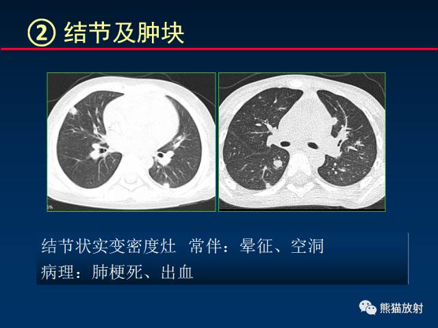 【PPT】小儿肺曲霉菌病相关CT表现分析