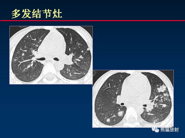 【PPT】小儿肺曲霉菌病相关CT表现分析