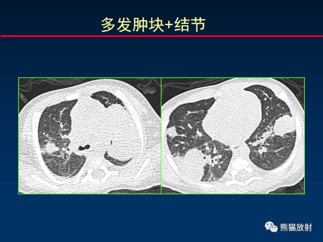 【PPT】小儿肺曲霉菌病相关CT表现分析