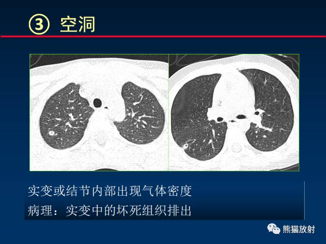 【PPT】小儿肺曲霉菌病相关CT表现分析