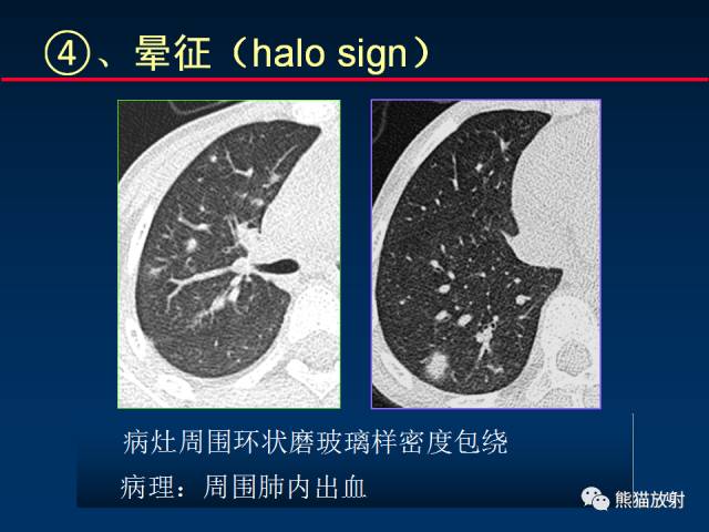 【PPT】小儿肺曲霉菌病相关CT表现分析