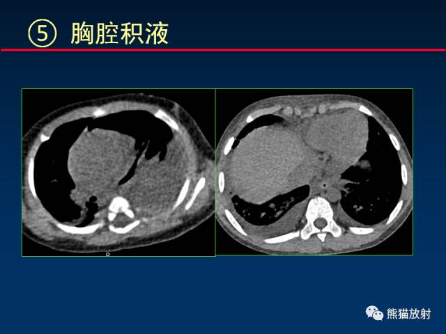 【PPT】小儿肺曲霉菌病相关CT表现分析