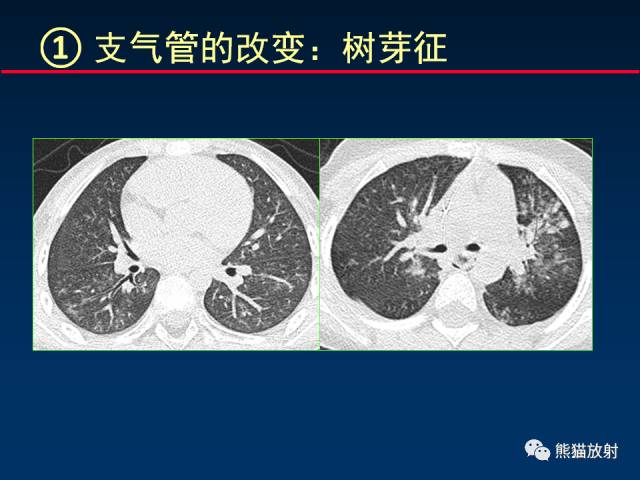 【PPT】小儿肺曲霉菌病相关CT表现分析