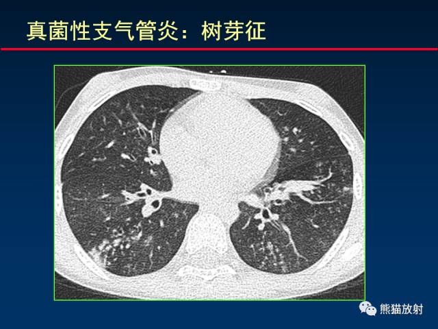 【PPT】小儿肺曲霉菌病相关CT表现分析