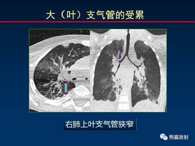 【PPT】小儿肺曲霉菌病相关CT表现分析