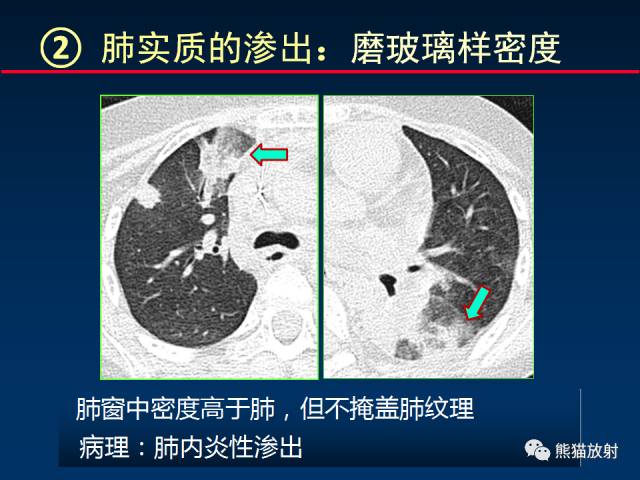 【PPT】小儿肺曲霉菌病相关CT表现分析