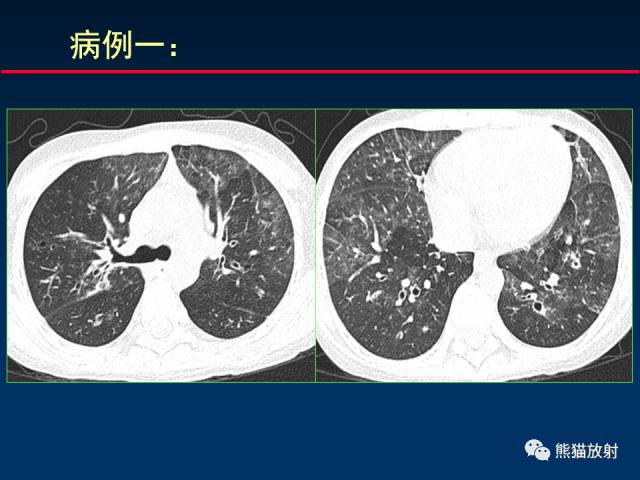 【PPT】小儿肺曲霉菌病相关CT表现分析