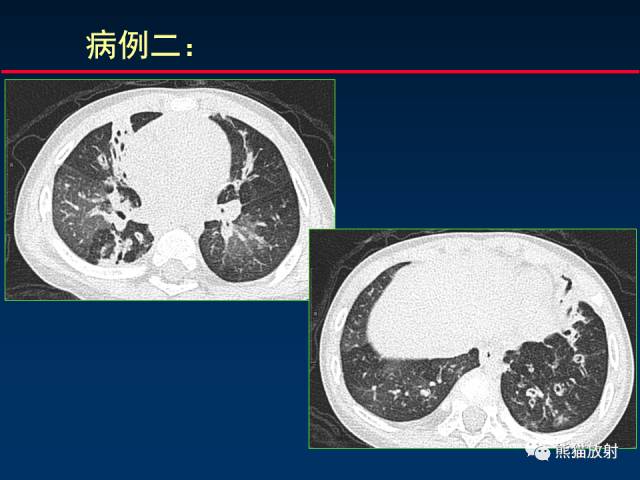 【PPT】小儿肺曲霉菌病相关CT表现分析