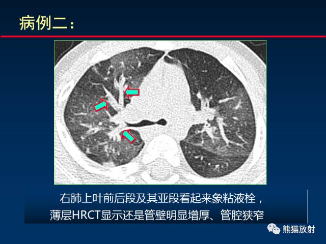 【PPT】小儿肺曲霉菌病相关CT表现分析
