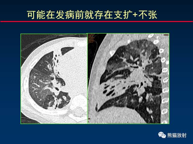 【PPT】小儿肺曲霉菌病相关CT表现分析