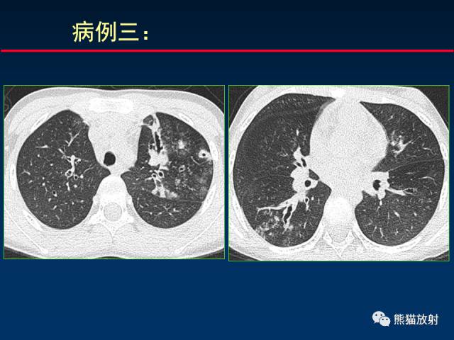 【PPT】小儿肺曲霉菌病相关CT表现分析