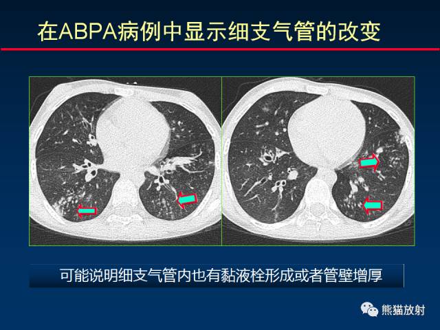【PPT】小儿肺曲霉菌病相关CT表现分析