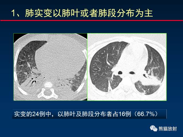 【PPT】小儿肺曲霉菌病相关CT表现分析