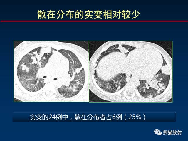 【PPT】小儿肺曲霉菌病相关CT表现分析