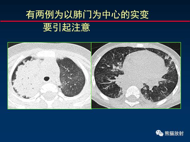 【PPT】小儿肺曲霉菌病相关CT表现分析