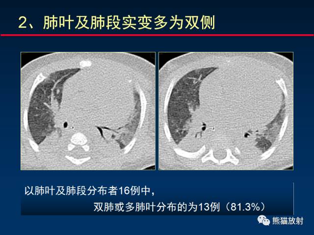 【PPT】小儿肺曲霉菌病相关CT表现分析