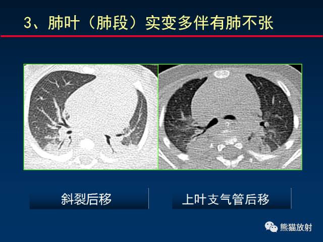 【PPT】小儿肺曲霉菌病相关CT表现分析