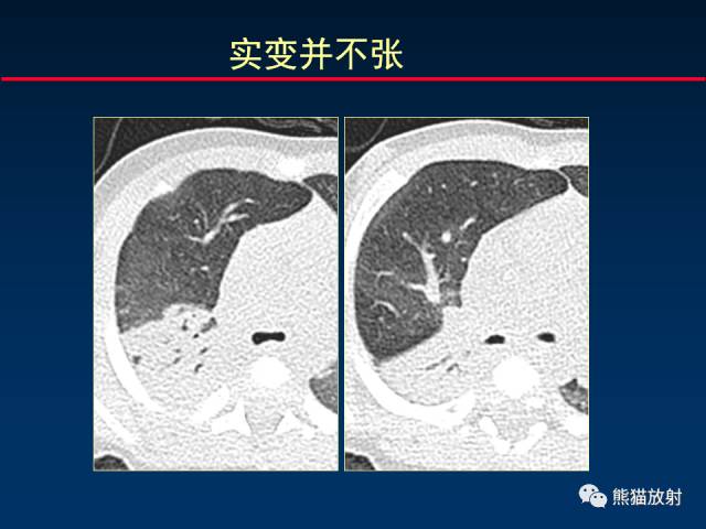 【PPT】小儿肺曲霉菌病相关CT表现分析