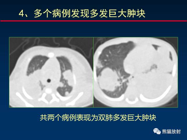 【PPT】小儿肺曲霉菌病相关CT表现分析