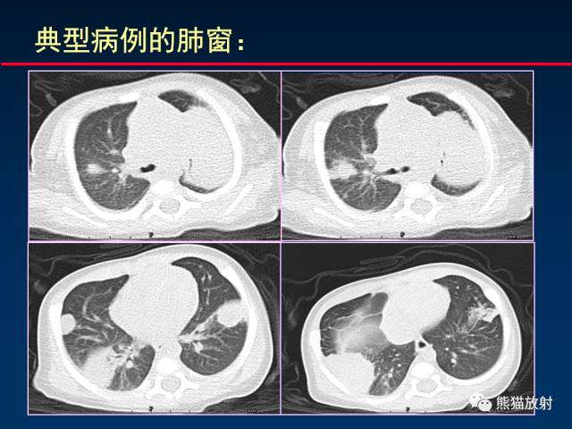 【PPT】小儿肺曲霉菌病相关CT表现分析