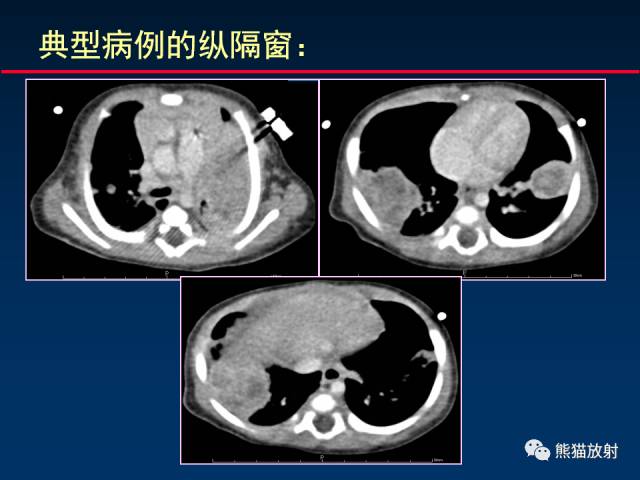 【PPT】小儿肺曲霉菌病相关CT表现分析