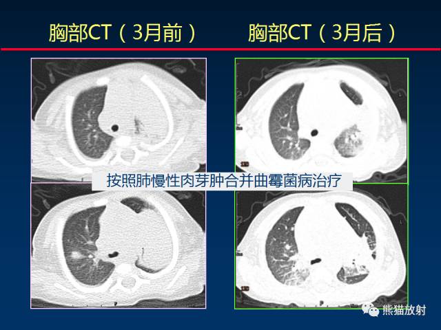【PPT】小儿肺曲霉菌病相关CT表现分析
