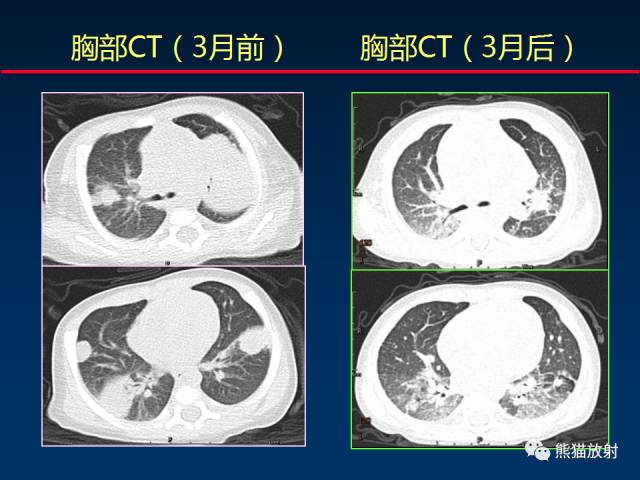 【PPT】小儿肺曲霉菌病相关CT表现分析