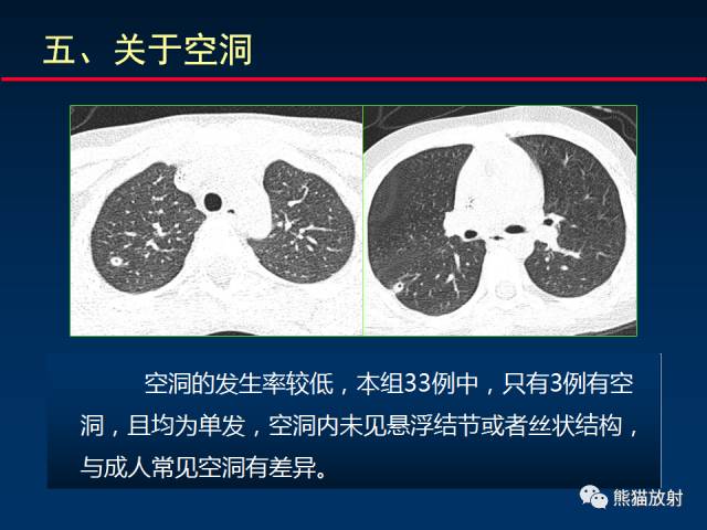 【PPT】小儿肺曲霉菌病相关CT表现分析