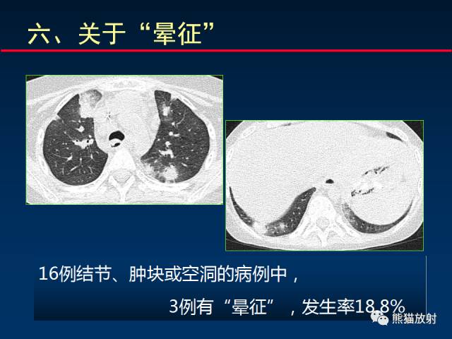 【PPT】小儿肺曲霉菌病相关CT表现分析